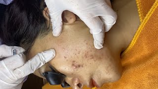 How to Treat Acne Properly Medical Standard acnetreatment skincare [upl. by Malet]