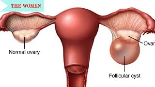 Overview of the Corpus LuteumCommon Gyn Problems [upl. by Zetta]