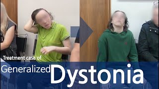 Dystonia  Generalized Dystonia  사경증  전신사경증 [upl. by Frasco]