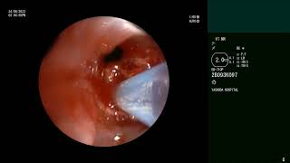 Paediatric airway stenosis  Cryomodality  Bronchoscopic recanalisation [upl. by Ainaj]