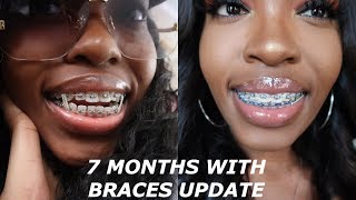 I HAVE BRACES 7 month braces journey  pictures and video progress open bite gaps elastics etc [upl. by Mailiw]