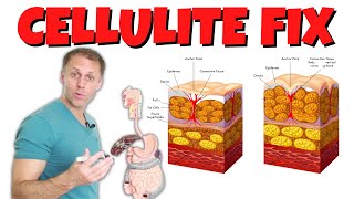 Understanding Cellulite and How to Fix It [upl. by Elgar]