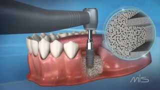 Implante SEVEN  Guía de procedimiento  MIS Implants [upl. by Brost]