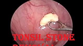 Tonsil Stone  Infected Cheesy Material Removal from Tonsillar Crypt [upl. by Mareah]