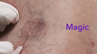 Magic vein sclerotherapy Watch spider veins disappear [upl. by Luane]