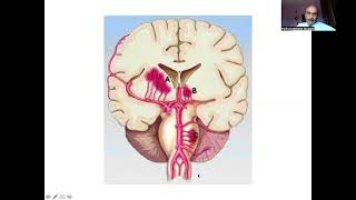 I Teach Medical Students Lacunar Stroke 2 [upl. by Klemperer]