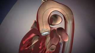 TAVR Edwards Sapien Aortic Valve Deployment [upl. by Annaiviv]