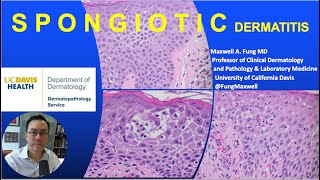 DERMATOPATHOLOGY Spongiotic Dermatitis [upl. by Lallage]