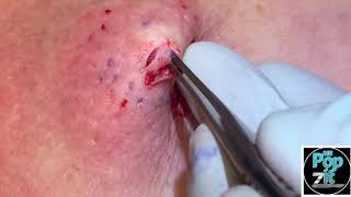 Chest popper blackhead with underlying cyst Big squeeze and cyst pop Full excision and closure [upl. by Nylorak]