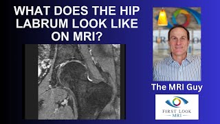 What does the hip labrum look like on MRI [upl. by Onig]