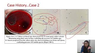 Candidiasis mimicking soft tissue lesion 2 cases at unusual location [upl. by Dylane183]