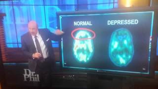 Normal Brain VS Depressed Brain [upl. by Ekal]