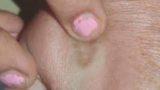 Granuloma annulare A rare skin disease [upl. by Osgood]