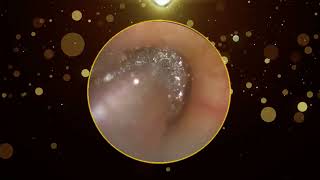 Ear Wax Removal [upl. by Stanley]