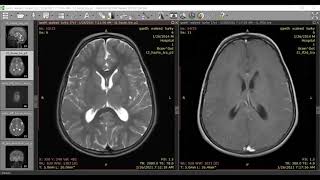 Optic pathway glioma NF1 [upl. by Sawyere183]