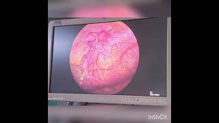 Laparoscopic Umbilical hernia repairIPOM PLUS [upl. by Lehmann]