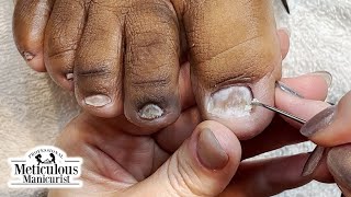 Toenail Fungus at Home Remedy [upl. by Odlavso]