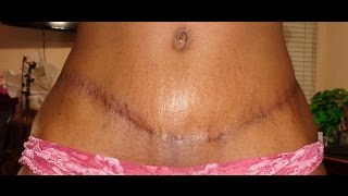 Tummy Tuck Surgery My Journey from Beginning to End [upl. by Schaeffer]