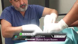 Otoplasty recovery day by day [upl. by Marcela]