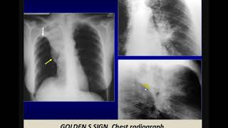 Imaging of bronchogenic carcinoma [upl. by Nogras665]