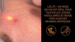 Tutoriel n°6  Traitement dun angiome stellaire avec le laser Elite par le Dr Patarin [upl. by Landri992]