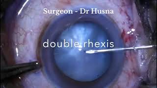 Double rhexis in intumescent cataract [upl. by Norved]