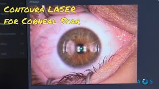 Contoura LASER Vision Correction for Corneal Scar  PTK and topoguided PRK surgery [upl. by Corrina]