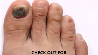 Is Toenail Fungus Black Know More about Toenail Fungus [upl. by Ahseina]