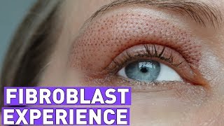 FIBROBLAST treatment experiencebefore and after 7 days [upl. by Junina444]