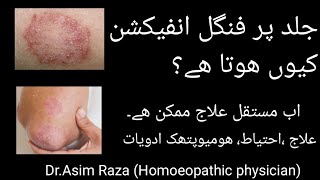 Fungal infection ka ilaj  Fungal infection treatment  Ringworm Homeopathic treatment [upl. by Norreg780]