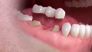 Straumann  Conventional 3unit bridge treatment [upl. by Zoara503]