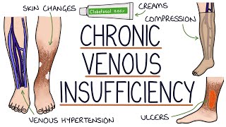 Understanding Chronic Venous Insufficiency [upl. by Verlee]