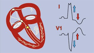 Left Bundle Branch Block and Sgarbossas Criteria [upl. by Cavuoto]