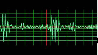 Infective Endocarditis Mitral Regurgitation normal speed [upl. by Randene]