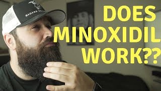 Is Minoxidil SAFE for a patchy beard  Things you NEED to know [upl. by Ahsrav]