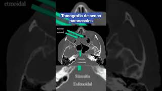 TOMOGRAFÍA DE SENOS PARANASALES RINOSINUSITIS [upl. by Aimahc841]