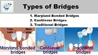 Types Of Dental Bridges [upl. by Etteyafal]