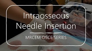 MRCEM OSCE 015  Intraosseous Needle Insertion [upl. by Hurd370]