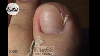 Relaxing ASMR Nail Care Gentle pedicure amp ingrown toenail removal at KIM 68 Spa  Ongle incarné [upl. by Alcot10]