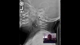 CROUP Anatomy and Pathology DISCUSSION by Radiologist [upl. by Nemrak819]