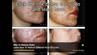 Acne Scar Treatment In The Philippines And AsiaWmv Scar Removal Philippines [upl. by Anayik]