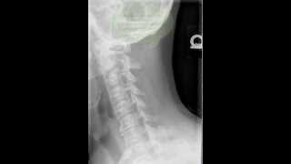 Cervical Spine Obliques Radiology Tutorial [upl. by Lehrer]