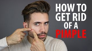 How To Get Rid of a Pimple Overnight  Fast Pimple and Acne Treatments  Alex Costa [upl. by Aneral]