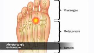 1 NEW Metatarsalgia Ball of the Foot Pain Neuroma Treatments [upl. by Johppah491]