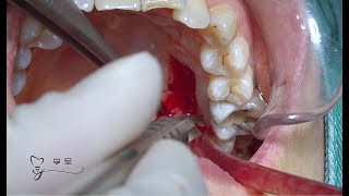 The harvesting of free gingival graft [upl. by Judsen660]