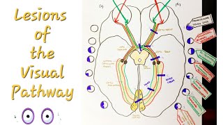 Lesions of the Visual Pathway  Optic Nerve and pathway lesions [upl. by Siraf281]