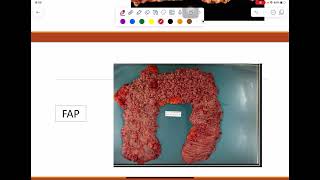 General pathology lab  Neoplasia part 2 [upl. by Kedezihclem]