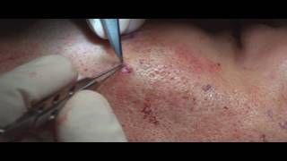 Acne Scar Revision Part 04 More Subcision Technique by Dr Young [upl. by Henrietta911]