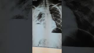 Is it hydropneumothorax really [upl. by Yllop]