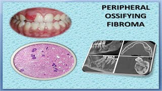 Peripheral Ossifying Fibroma [upl. by Zwart]